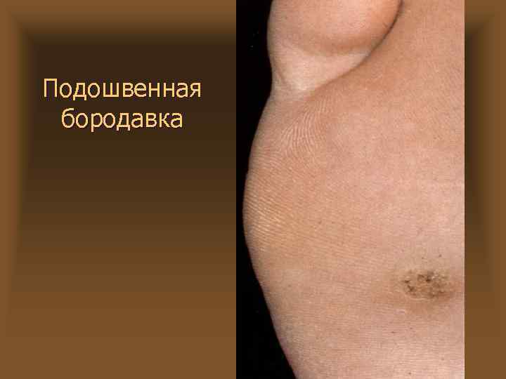 Подошвенная бородавка 