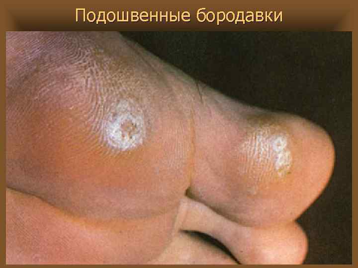 Подошвенные бородавки 