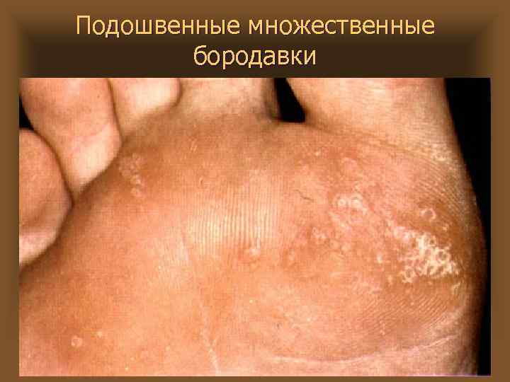 Подошвенные множественные бородавки 