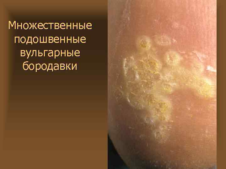 Множественные подошвенные вульгарные бородавки 