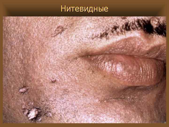 Нитевидные 