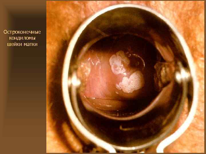 Остроконечные кондиломы шейки матки 