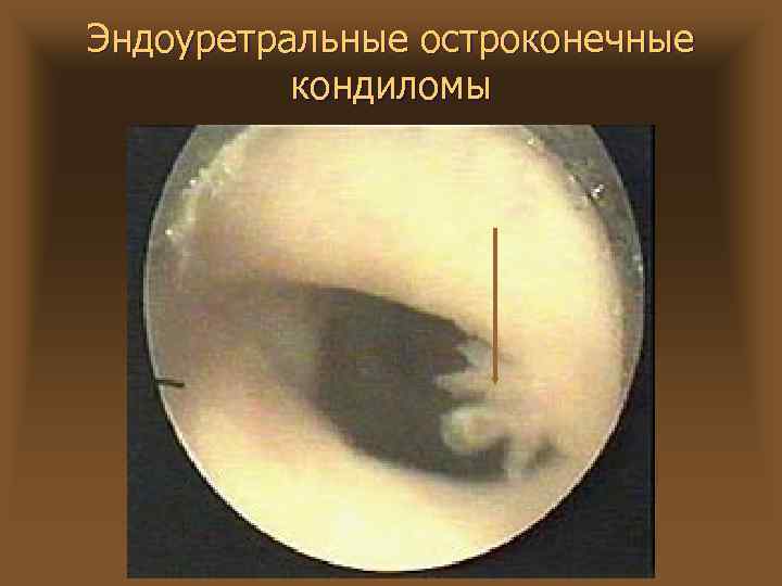 Эндоуретральные остроконечные кондиломы 