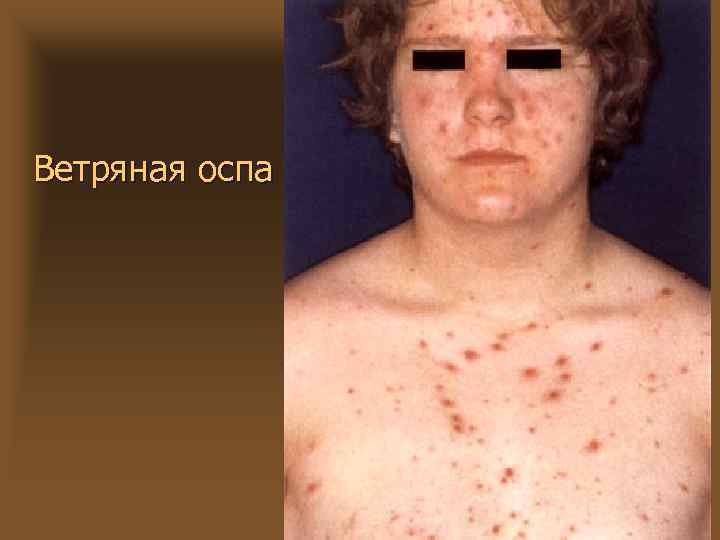 Ветряная оспа 