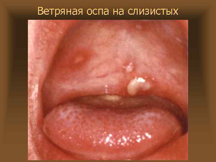 Ветряная оспа на слизистых 