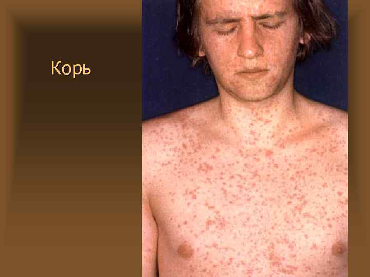 Корь 