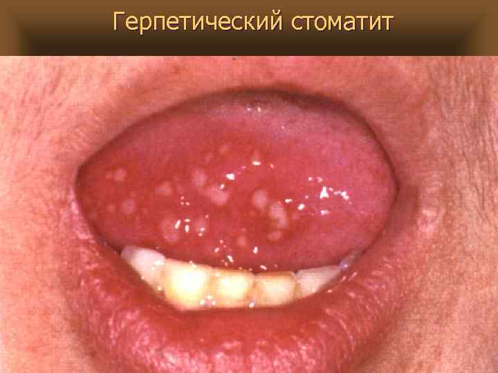 Герпетический стоматит 