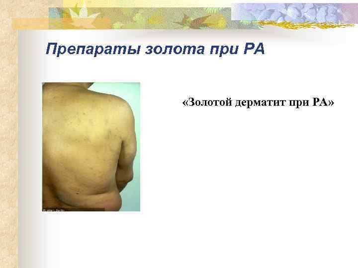 Препараты золота при РА «Золотой дерматит при РА» 