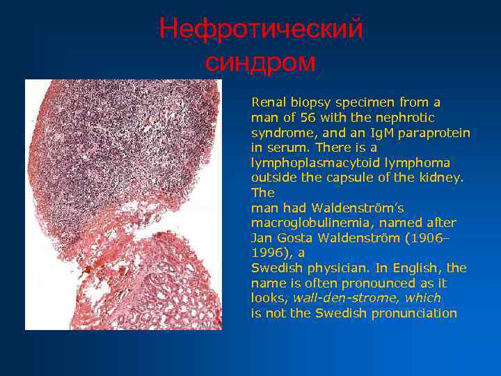 Нефротический синдром Renal biopsy specimen from a man of 56 with the nephrotic syndrome,