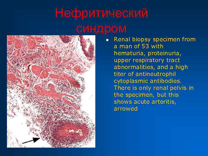 Нефритический синдром n Renal biopsy specimen from a man of 53 with hematuria, proteinuria,