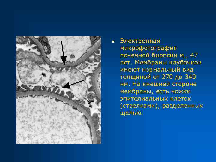 n Электронная микрофотография почечной биопсии м. , 47 лет. Мембраны клубочков имеют нормальный вид