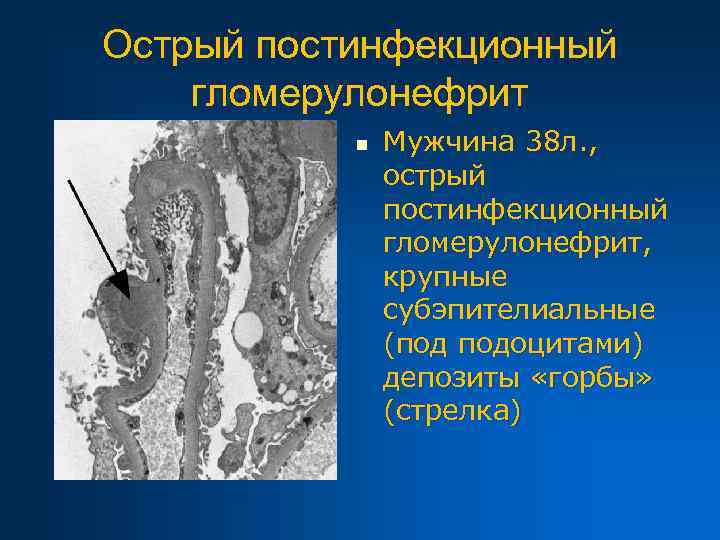 Острый постинфекционный гломерулонефрит n Мужчина 38 л. , острый постинфекционный гломерулонефрит, крупные субэпителиальные (под