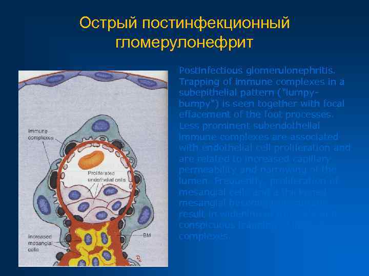 Острый постинфекционный гломерулонефрит Postinfectious glomerulonephritis. Trapping of immune complexes in a subepithelial pattern ("lumpybumpy")