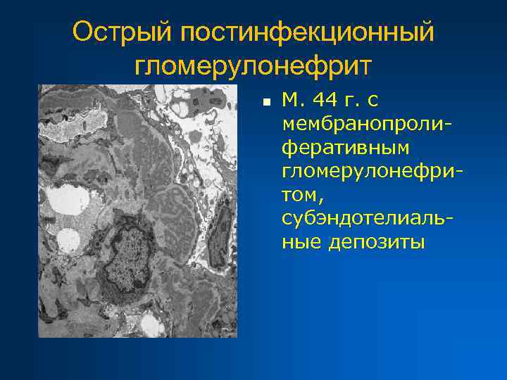 Острый постинфекционный гломерулонефрит n М. 44 г. с мембранопролиферативным гломерулонефритом, субэндотелиальные депозиты 