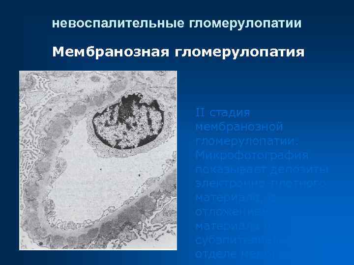 невоспалительные гломерулопатии Мембранозная гломерулопатия II стадия мембранозной гломерулопатии. Микрофотография показывает депозиты электронно-плотного материала, с