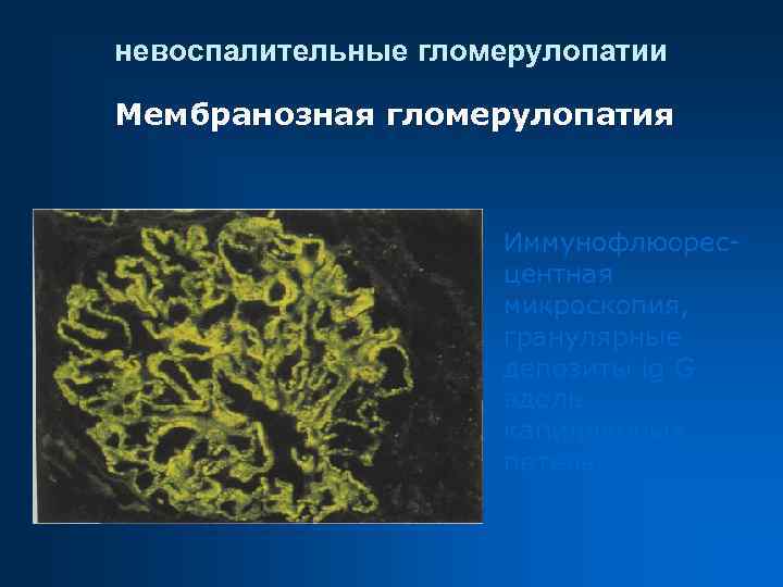 невоспалительные гломерулопатии Мембранозная гломерулопатия Иммунофлюоресцентная микроскопия, гранулярные депозиты ig G вдоль капиллярных петель. 