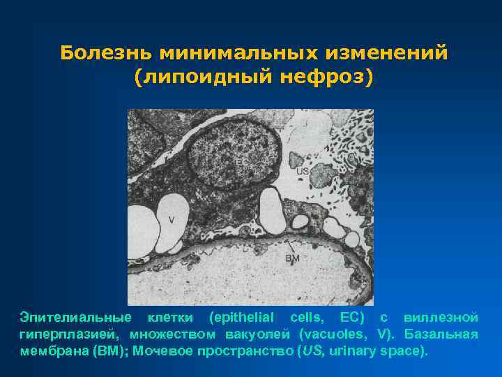 Болезнь минимальных изменений (липоидный нефроз) Эпителиальные клетки (epithelial cells, EC) с виллезной гиперплазией, множеством