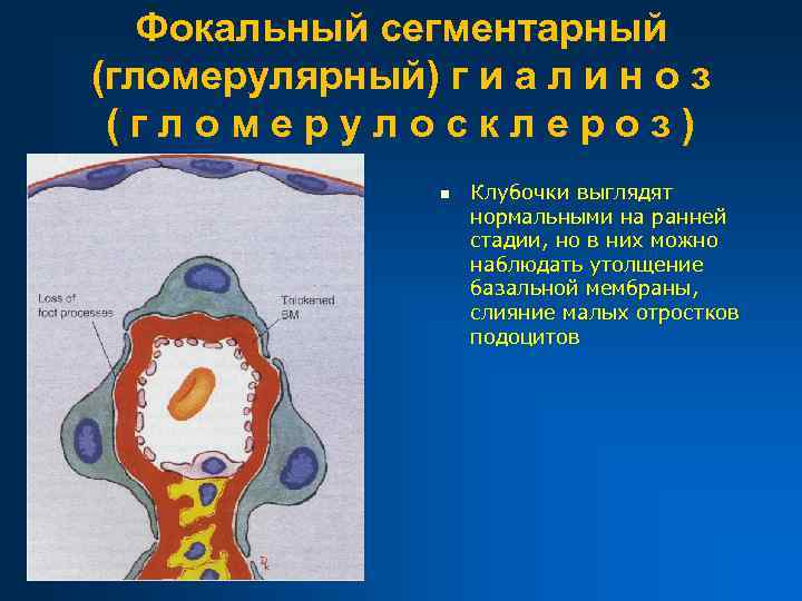 Фокальный сегментарный (гломерулярный) г и а л и н о з (гломерулосклероз) n Клубочки