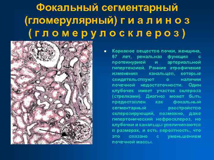 Фокальный сегментарный (гломерулярный) г и а л и н о з (гломерулосклероз) n Корковое