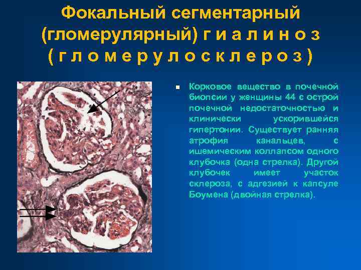 Фокальный сегментарный (гломерулярный) г и а л и н о з (гломерулосклероз) n Корковое