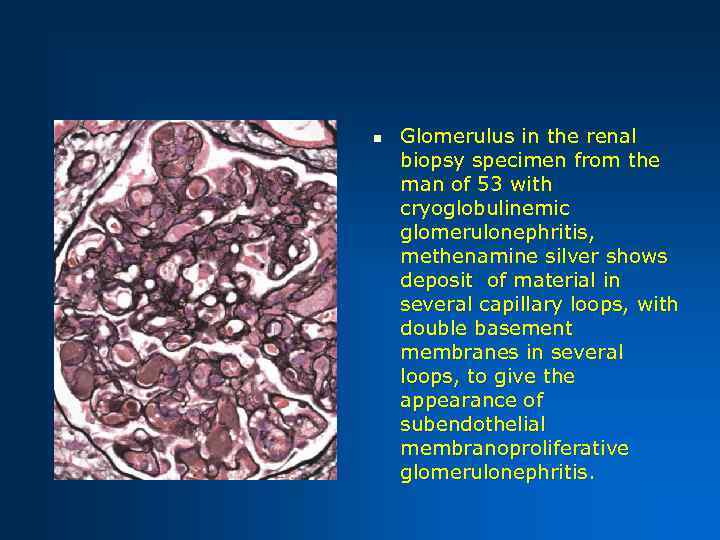 n Glomerulus in the renal biopsy specimen from the man of 53 with cryoglobulinemic