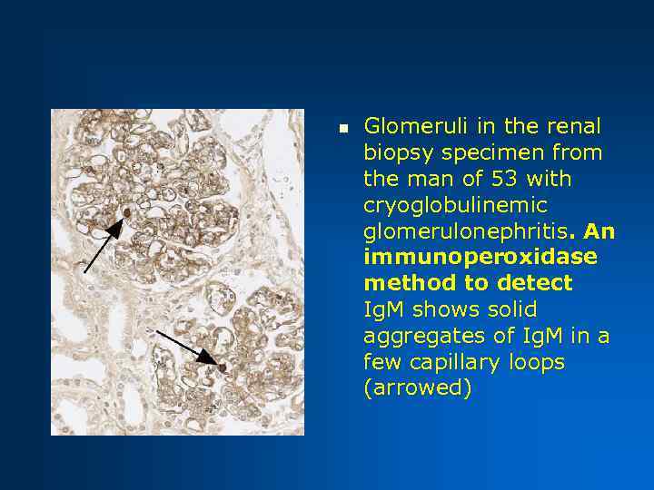 n Glomeruli in the renal biopsy specimen from the man of 53 with cryoglobulinemic