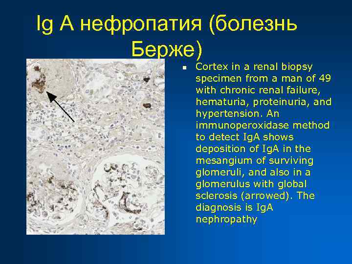 Ig A нефропатия (болезнь Берже) n Cortex in a renal biopsy specimen from a