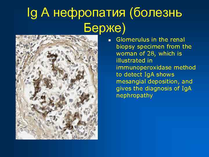 Ig A нефропатия (болезнь Берже) n Glomerulus in the renal biopsy specimen from the