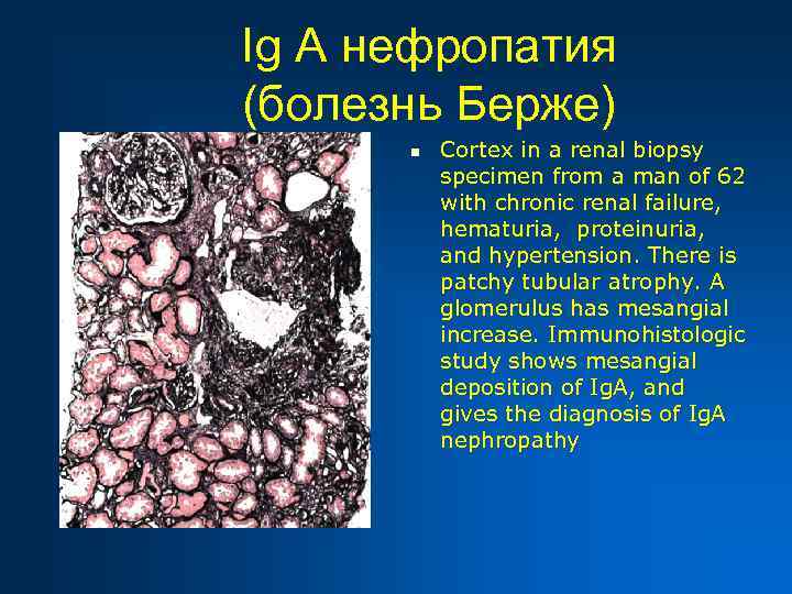 Берже болезнь презентация