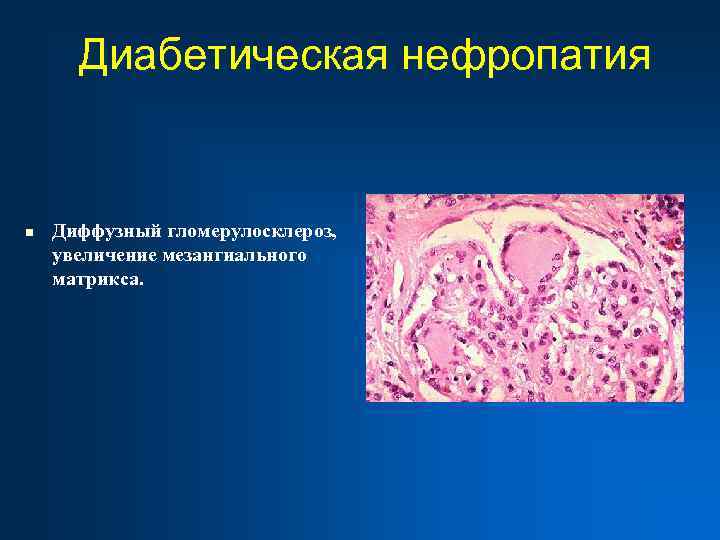 Диабетическая нефропатия n Диффузный гломерулосклероз, увеличение мезангиального матрикса. 