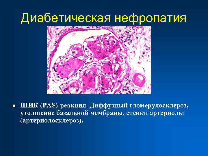 Диабетическая нефропатия n ШИК (PAS)-реакция. Диффузный гломерулосклероз, утолщение базальной мембраны, стенки артериолы (артериолосклероз). 