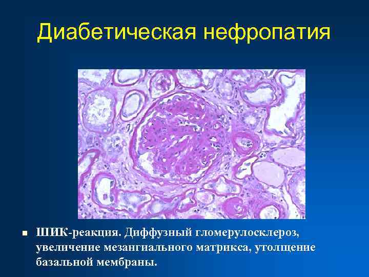 Диабетическая нефропатия n ШИК-реакция. Диффузный гломерулосклероз, увеличение мезангиального матрикса, утолщение базальной мембраны. 