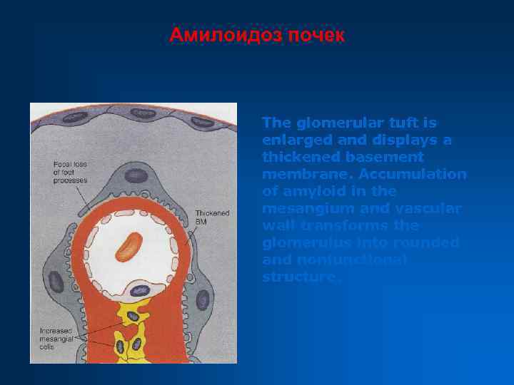 Амилоидоз почек The glomerular tuft is enlarged and displays a thickened basement membrane. Accumulation