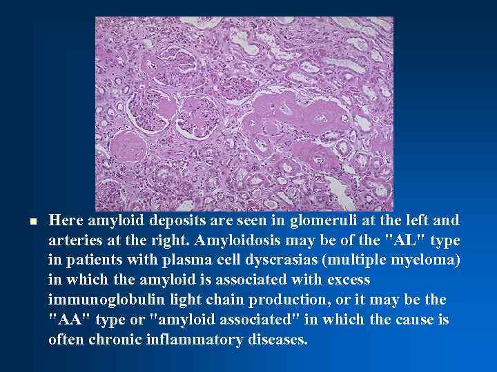 n Here amyloid deposits are seen in glomeruli at the left and arteries at