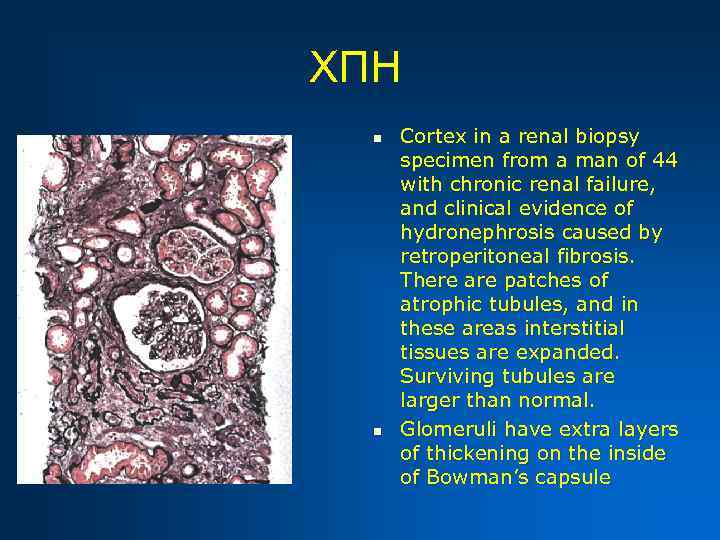 ХПН n n Cortex in a renal biopsy specimen from a man of 44