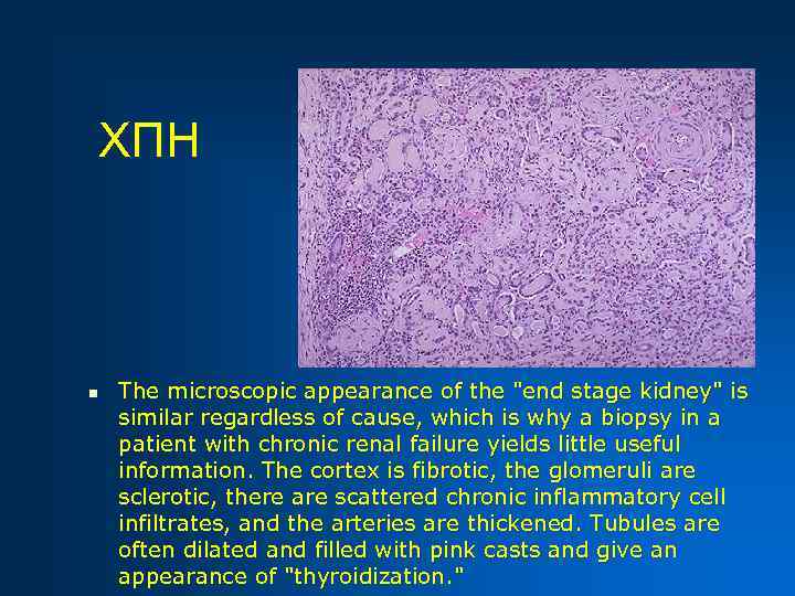 ХПН n The microscopic appearance of the "end stage kidney" is similar regardless of