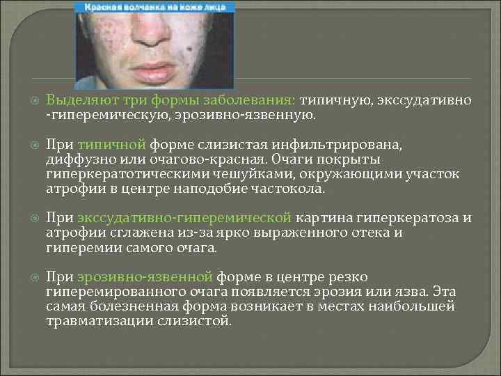  Выделяют три формы заболевания: типичную, экссудативно -гиперемическую, эрозивно-язвенную. При типичной форме слизистая инфильтрирована,