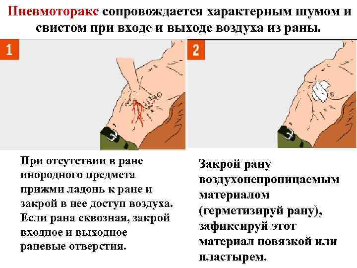  Пневмоторакс сопровождается характерным шумом и свистом при входе и выходе воздуха из раны.