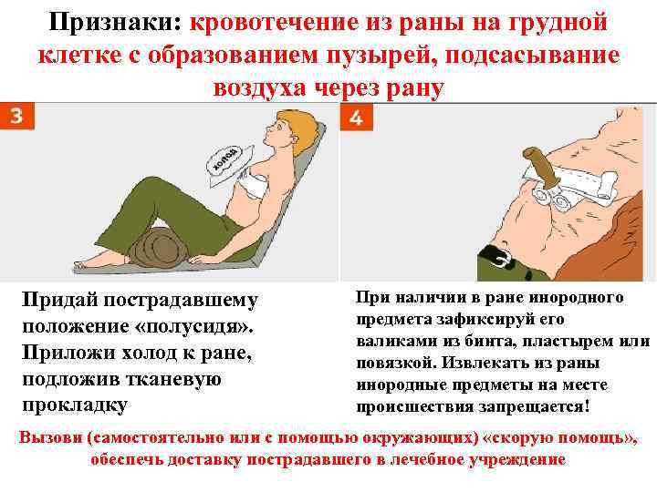 Признаки: кровотечение из раны на грудной клетке с образованием пузырей, подсасывание воздуха через рану