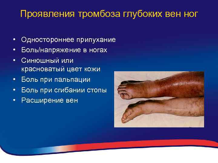 Проявления тромбоза глубоких вен ног • Одностороннее припухание • Боль/напряжение в ногах • Синюшный