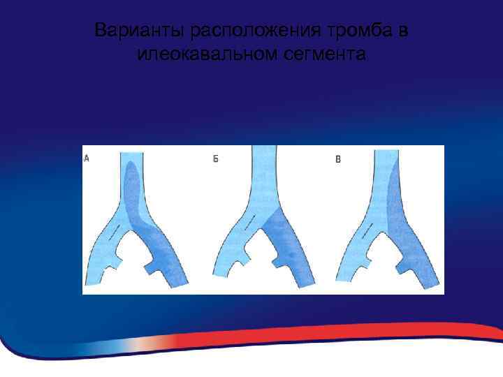 Варианты расположения тромба в илеокавальном сегмента 