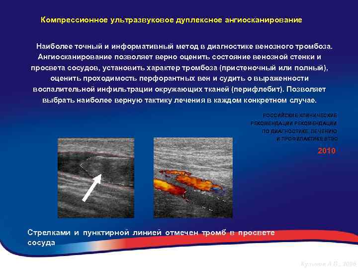  Компрессионное ультразвуковое дуплексное ангиосканирование Наиболее точный и информативный метод в диагностике венозного тромбоза.