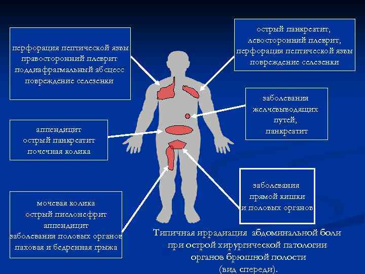 перфорация пептической язвы правосторонний плеврит поддиафрагмальный абсцесс повреждение селезенки аппендицит острый панкреатит почечная колика