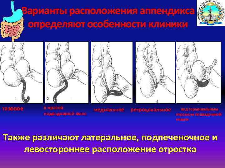 Особенности клинической картины острого аппендицита при тазовом расположении червеобразного отростка