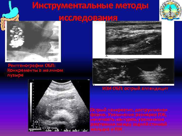 Инструментальные методы исследования Рентгенография ОБП: Конкременты в желчном пузыре ИЗИ ОБП: острый аппендицит Острый