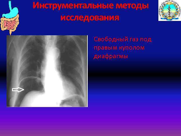 Инструментальные методы исследования Свободный газ под правым куполом диафрагмы 