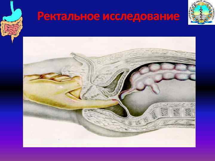 Ректальное исследование 