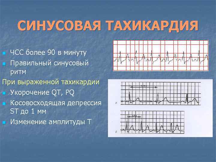 СИНУСОВАЯ ТАХИКАРДИЯ ЧСС более 90 в минуту n Правильный синусовый ритм При выраженной тахикардии