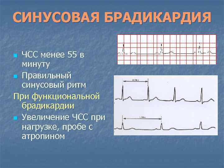 СИНУСОВАЯ БРАДИКАРДИЯ ЧСС менее 55 в минуту n Правильный синусовый ритм При функциональной брадикардии