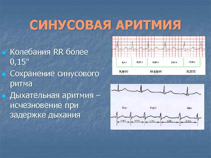 СИНУСОВАЯ АРИТМИЯ n n n Колебания RR более 0, 15